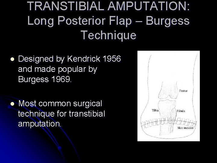 TRANSTIBIAL AMPUTATION: Long Posterior Flap – Burgess Technique l Designed by Kendrick 1956 and