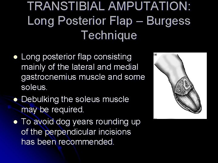 TRANSTIBIAL AMPUTATION: Long Posterior Flap – Burgess Technique l l l Long posterior flap