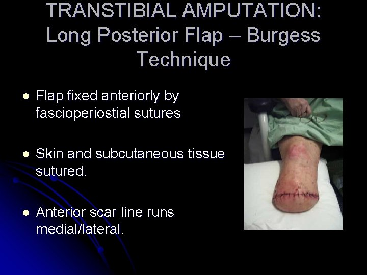 TRANSTIBIAL AMPUTATION: Long Posterior Flap – Burgess Technique l Flap fixed anteriorly by fascioperiostial