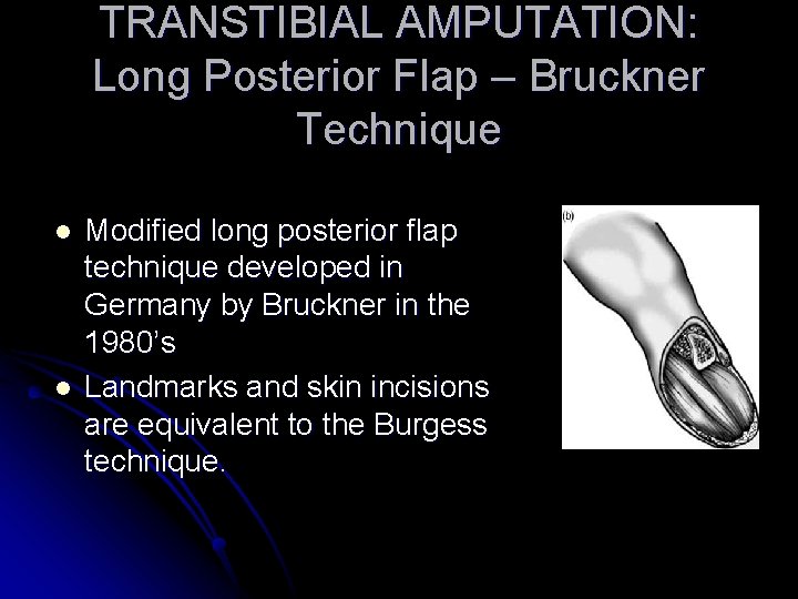 TRANSTIBIAL AMPUTATION: Long Posterior Flap – Bruckner Technique l l Modified long posterior flap
