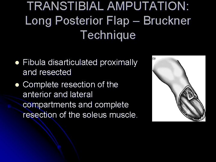 TRANSTIBIAL AMPUTATION: Long Posterior Flap – Bruckner Technique l l Fibula disarticulated proximally and