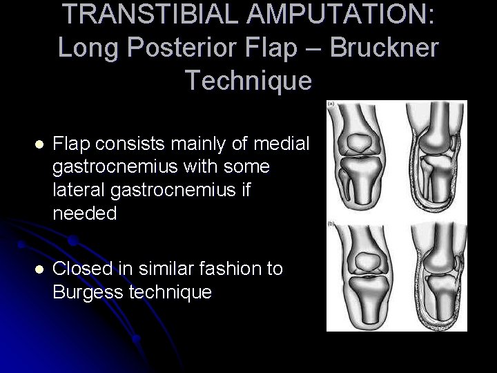 TRANSTIBIAL AMPUTATION: Long Posterior Flap – Bruckner Technique l Flap consists mainly of medial