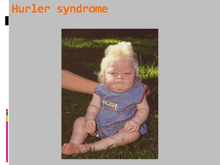 Hurler syndrome 