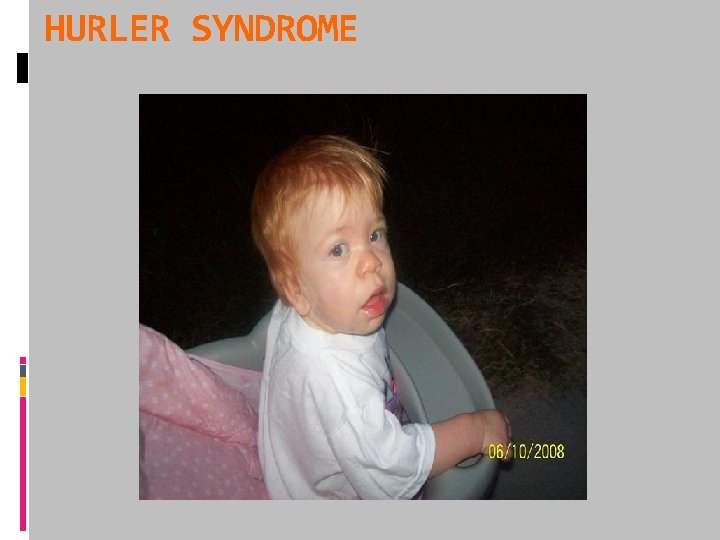 HURLER SYNDROME 