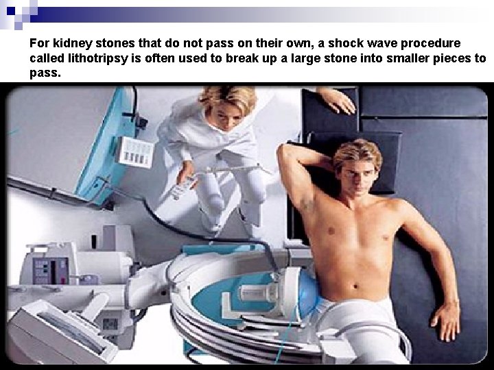 For kidney stones that do not pass on their own, a shock wave procedure