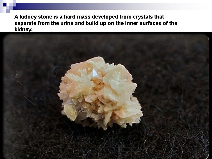 A kidney stone is a hard mass developed from crystals that separate from the