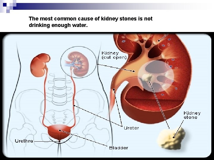 The most common cause of kidney stones is not drinking enough water. 