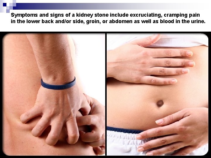 Symptoms and signs of a kidney stone include excruciating, cramping pain in the lower