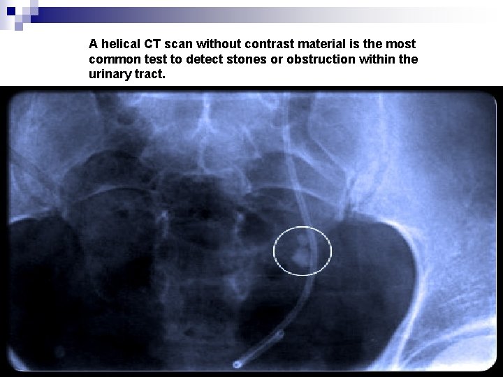 A helical CT scan without contrast material is the most common test to detect