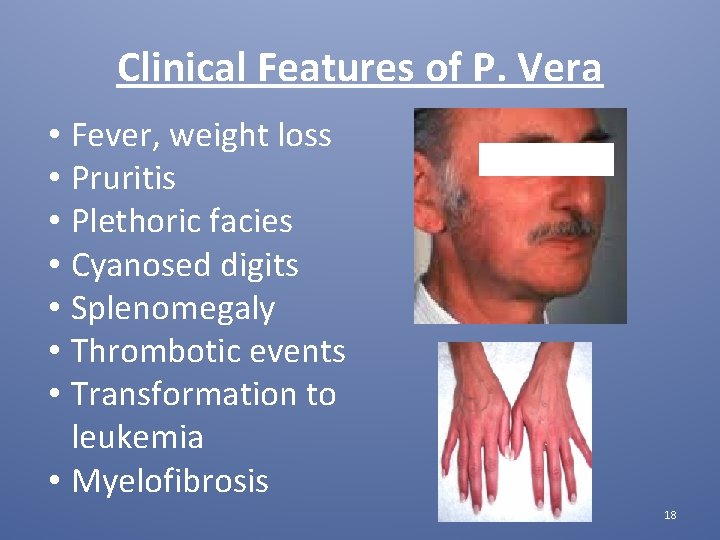 Clinical Features of P. Vera • Fever, weight loss • Pruritis • Plethoric facies