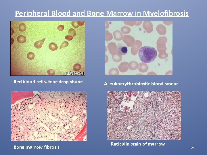 Peripheral Blood and Bone Marrow in Myelofibrosis Red blood cells, tear-drop shape Bone marrow