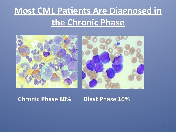 Most CML Patients Are Diagnosed in the Chronic Phase 80% Blast Phase 10% 5