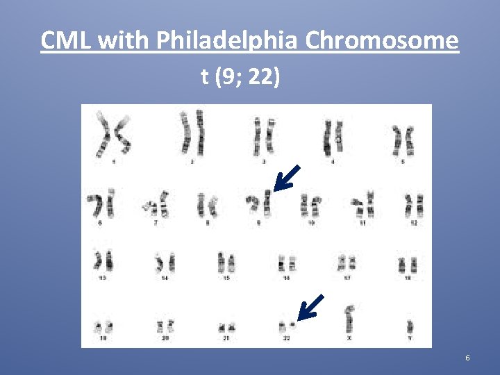 CML with Philadelphia Chromosome t (9; 22) 6 