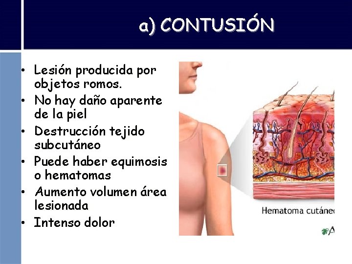 a) CONTUSIÓN • Lesión producida por objetos romos. • No hay daño aparente de