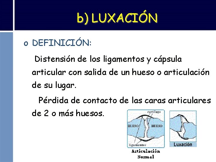 b) LUXACIÓN o DEFINICIÓN: Distensión de los ligamentos y cápsula articular con salida de