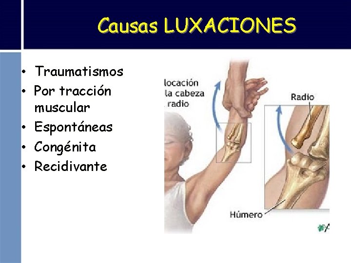 Causas LUXACIONES • Traumatismos • Por tracción muscular • Espontáneas • Congénita • Recidivante