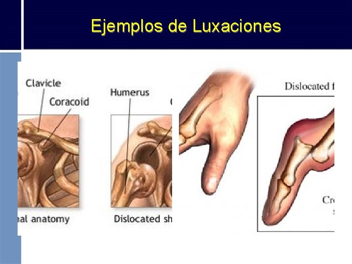 Ejemplos de Luxaciones 