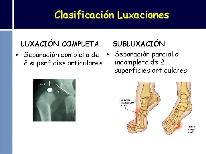 Clasificación Luxaciones LUXACIÓN COMPLETA SUBLUXACIÓN • Separación completa de • Separación parcial o incompleta