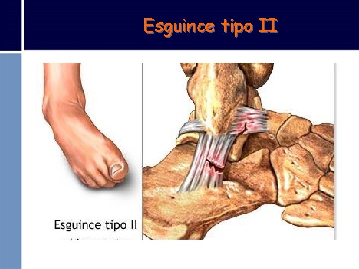 Esguince tipo II 