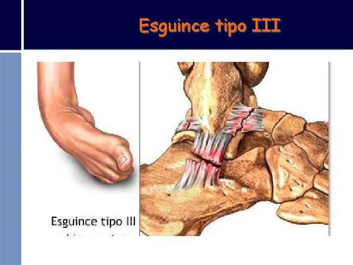 Esguince tipo III 