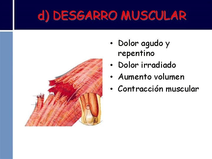 d) DESGARRO MUSCULAR • Dolor agudo y repentino • Dolor irradiado • Aumento volumen