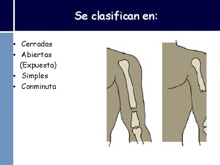 Se clasifican en: • Cerradas • Abiertas (Expuesta) • Simples • Conminuta 