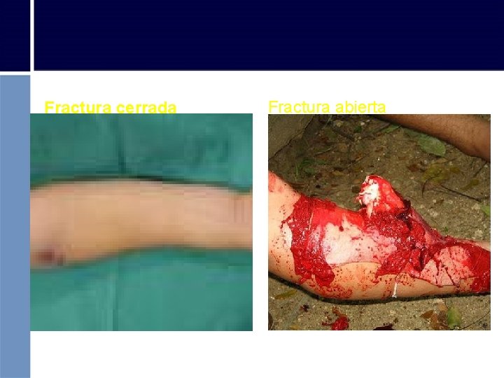 Fractura cerrada Fractura abierta 