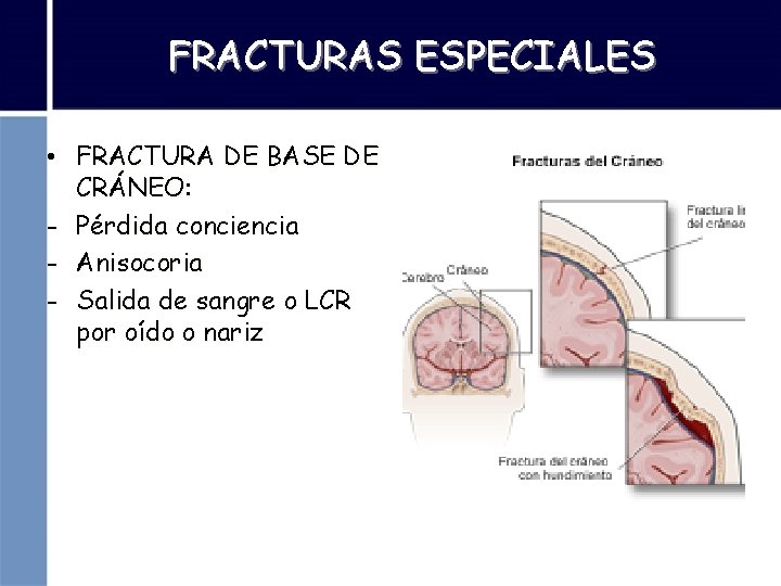 FRACTURAS ESPECIALES • FRACTURA DE BASE DE CRÁNEO: - Pérdida conciencia - Anisocoria -