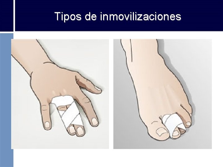 Tipos de inmovilizaciones 