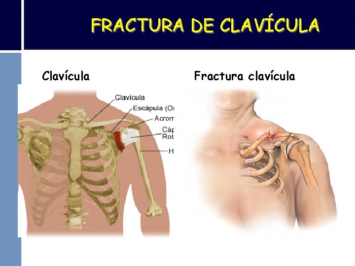 FRACTURA DE CLAVÍCULA Clavícula Fractura clavícula 