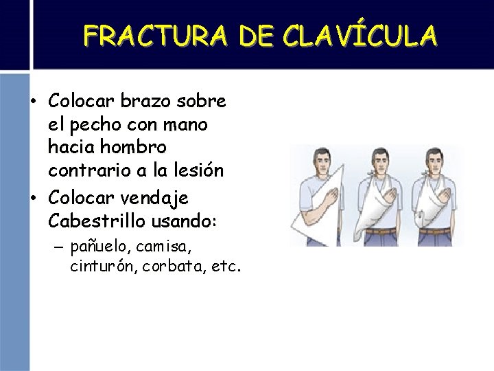 FRACTURA DE CLAVÍCULA • Colocar brazo sobre el pecho con mano hacia hombro contrario