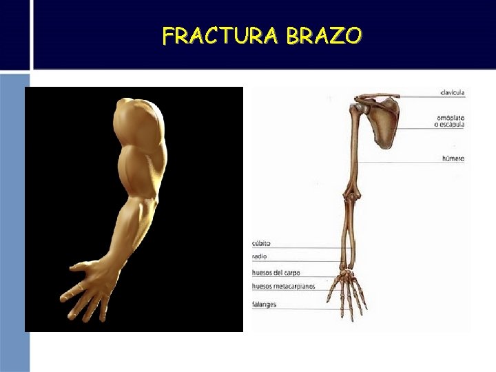 FRACTURA BRAZO 