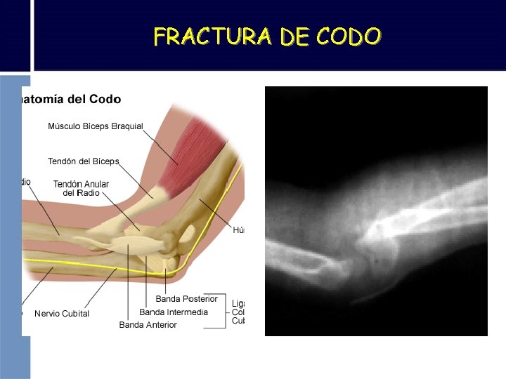 FRACTURA DE CODO 