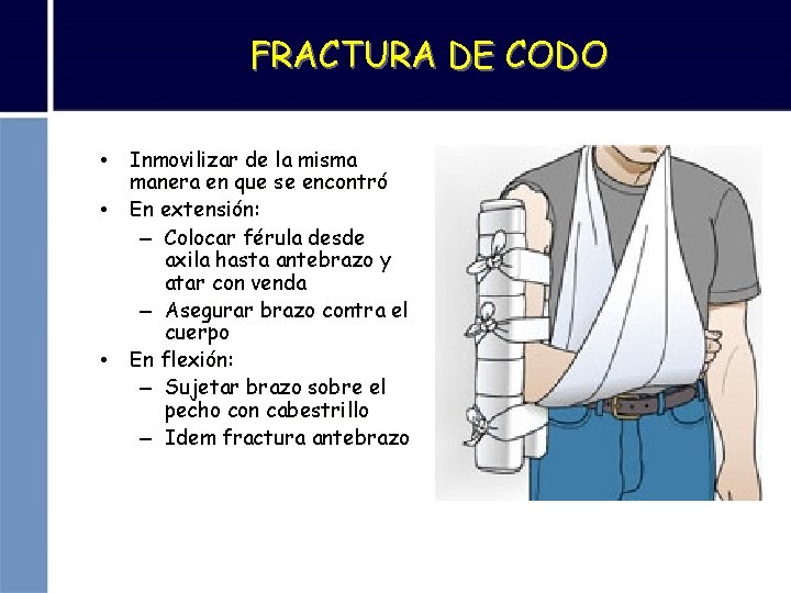 FRACTURA DE CODO • Inmovilizar de la misma manera en que se encontró •