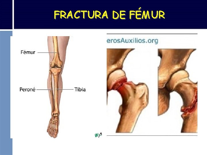 FRACTURA DE FÉMUR 