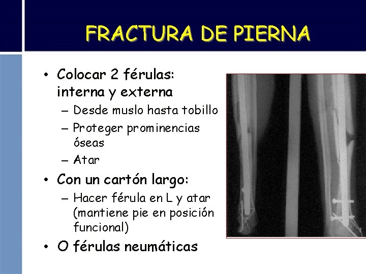 FRACTURA DE PIERNA • Colocar 2 férulas: interna y externa – Desde muslo hasta