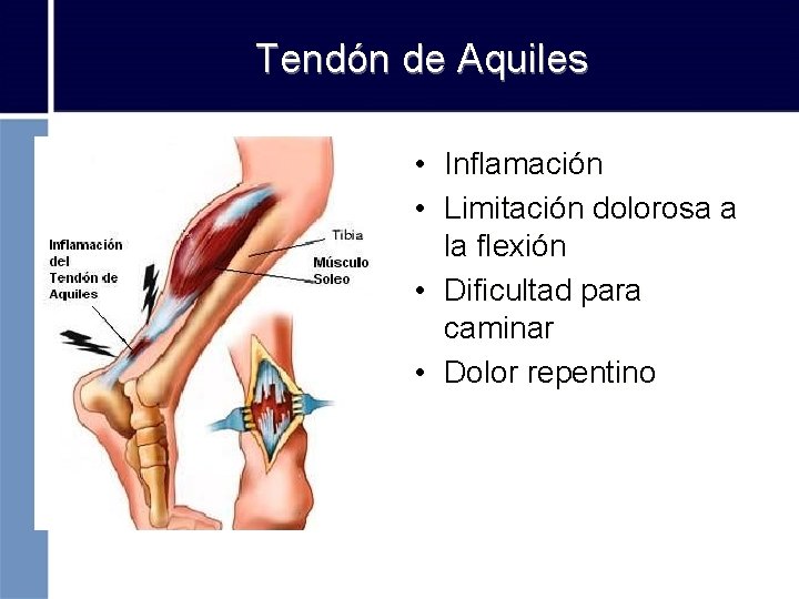 Tendón de Aquiles • Inflamación • Limitación dolorosa a la flexión • Dificultad para