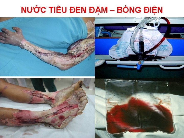 NƯỚC TIỂU ĐEN ĐẬM – BỎNG ĐIỆN 24/11/2020 14 