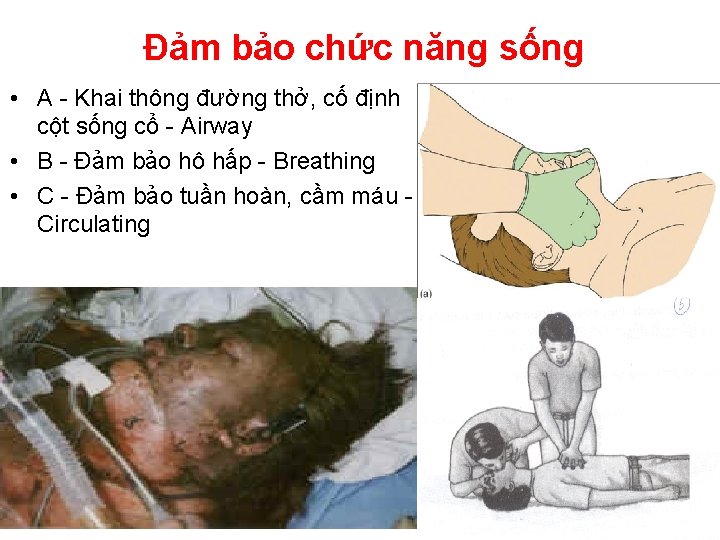 Đảm bảo chức năng sống • A - Khai thông đường thở, cố định
