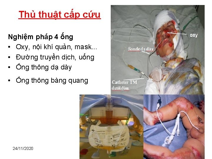 Thủ thuật cấp cứu Nghiệm pháp 4 ống • Oxy, nội khí quản, mask.