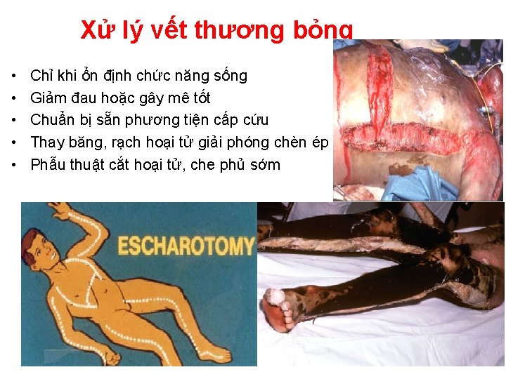Xử lý vết thương bỏng • • • Chỉ khi ổn định chức năng