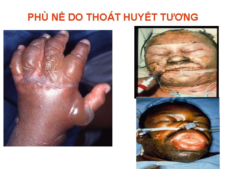 PHÙ NỀ DO THOÁT HUYẾT TƯƠNG 