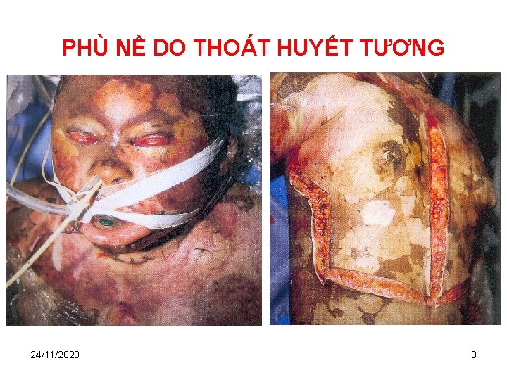 PHÙ NỀ DO THOÁT HUYẾT TƯƠNG 24/11/2020 9 