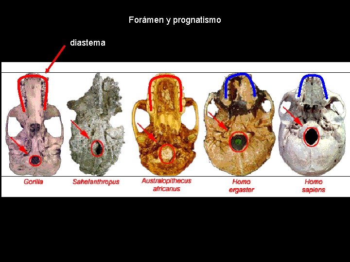 Forámen y prognatismo diastema 