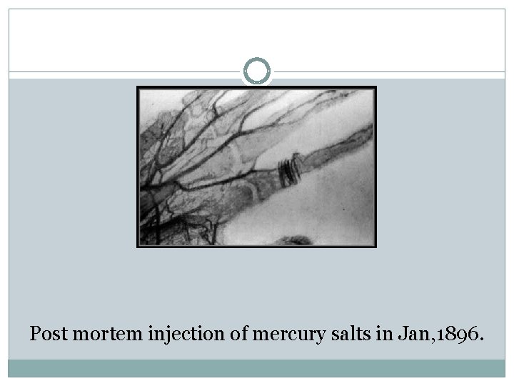 Post mortem injection of mercury salts in Jan, 1896. 