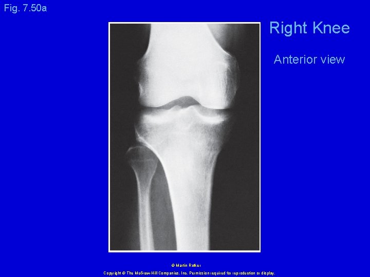 Fig. 7. 50 a Right Knee Anterior view © Martin Rotker Copyright © The