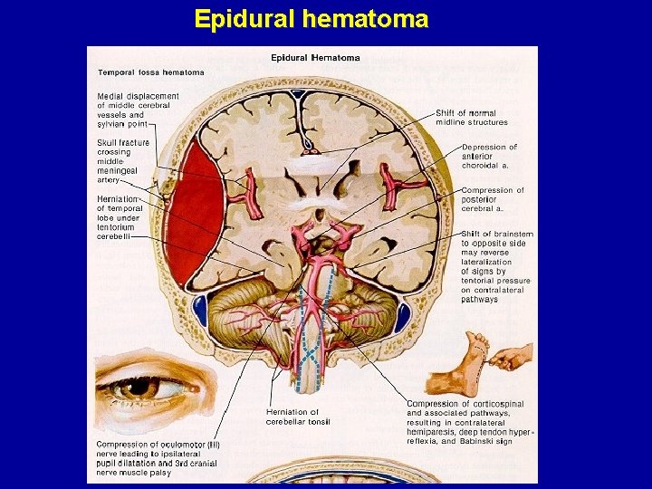Epidural hematoma 