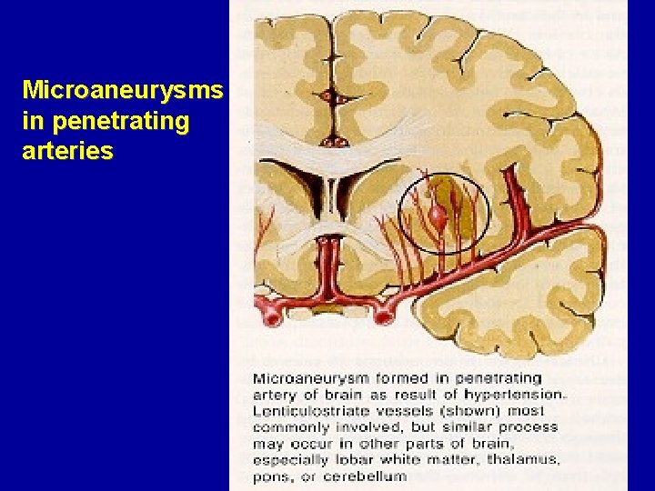Microaneurysms in penetrating arteries 