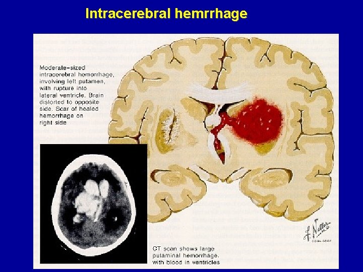 Intracerebral hemrrhage 