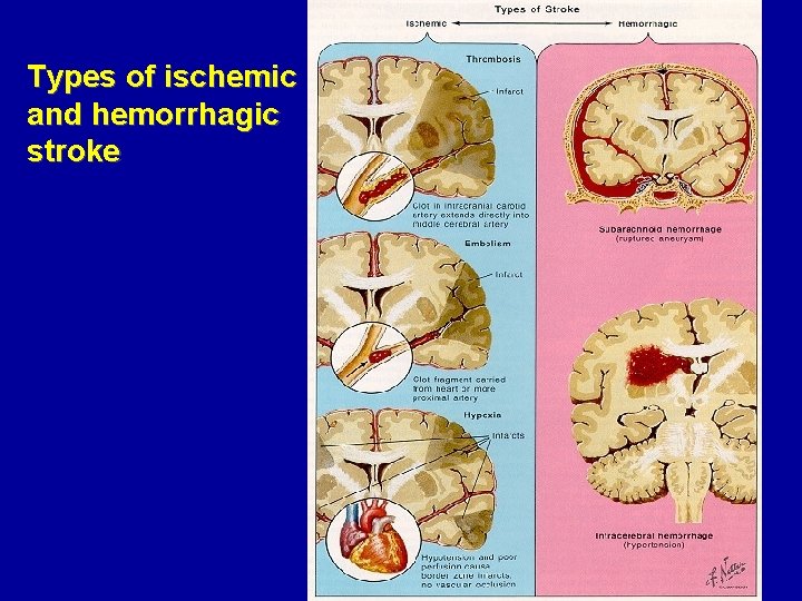 Types of ischemic and hemorrhagic stroke 